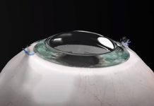 Новая синтетическая роговица позволяет слепому полностью восстановить зрение